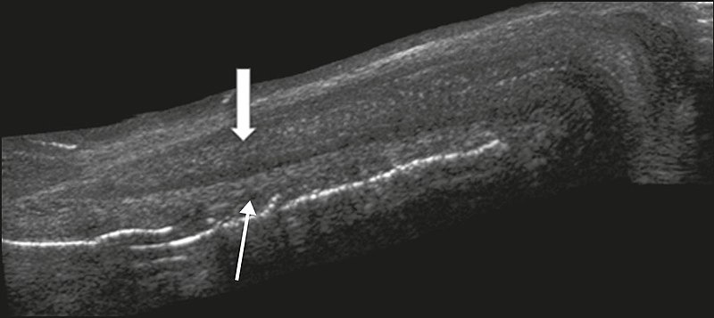 ongoing treatment of Peyronie’s disease>