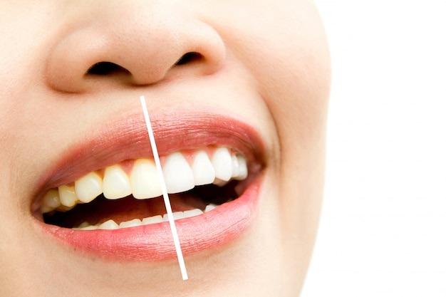 To reduce teeth sensitivity after the treatment you take some steps